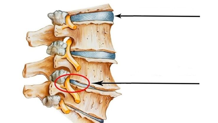 Kecederaan pada tulang belakang pada osteochondrosis serviks