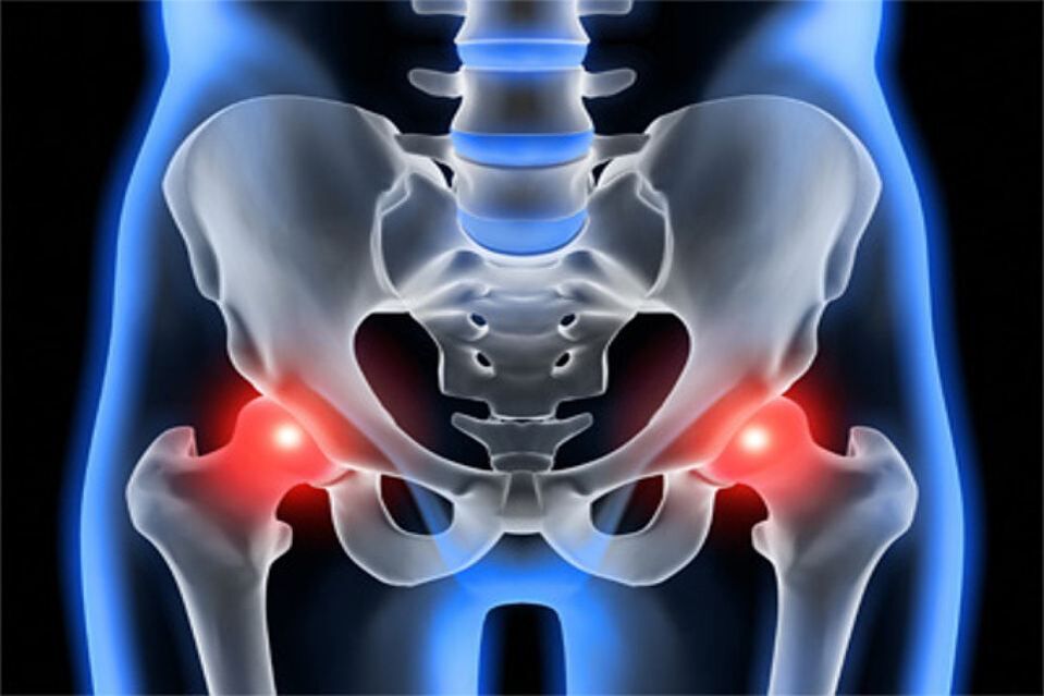 Merosakkan osteoartritis sendi pinggul (coxarthrosis)