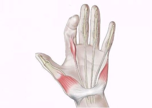 Keradangan tendon sebagai punca kesakitan pada sendi jari