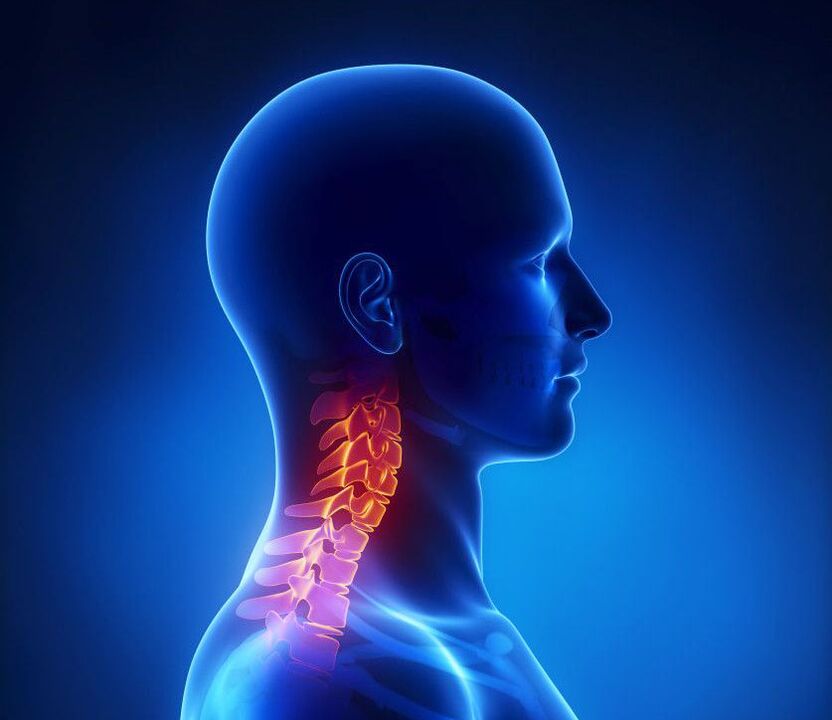 Osteochondrosis serviks adalah patologi tulang belakang yang boleh anda singkirkan di rumah