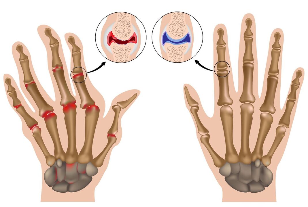 Pergelangan tangan dan pergelangan tangan yang sihat terjejas oleh poliartritis