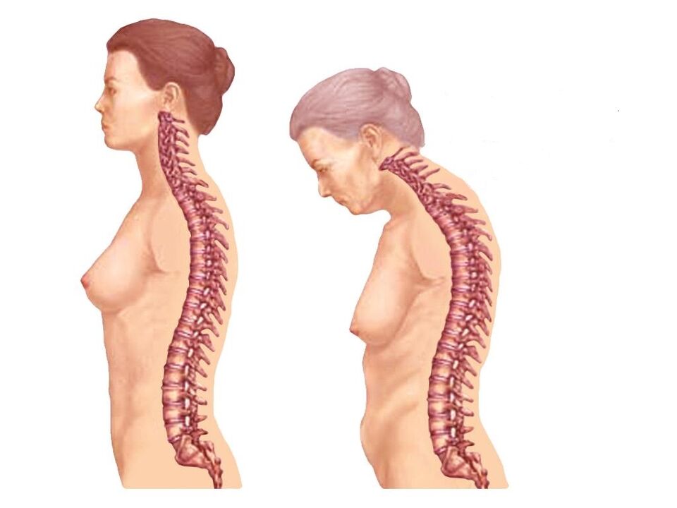 tulang belakang melengkung yang sihat dengan osteochondrosis