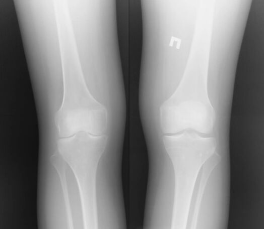 Imej x -ray sendi lutut