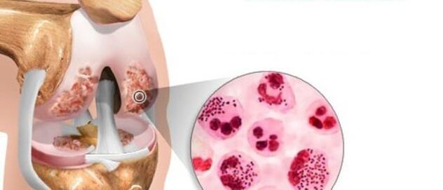 Ini membawa kepada perkembangan osteoarthritis