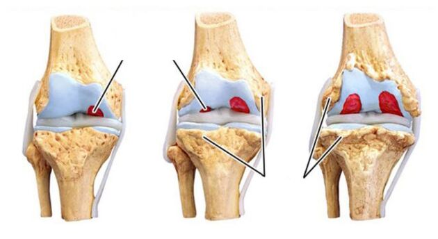 Komplikasi arthrosis sendi