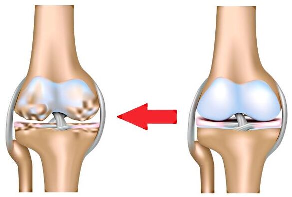 Sendi yang sihat dan osteoarthritis