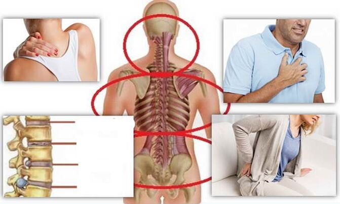 Lokasi Penyakit untuk Osteochondrosis