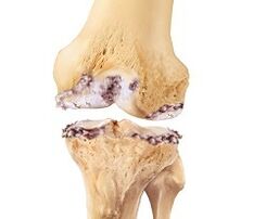 Kerosakan pada sendi lutut akibat osteoarthritis