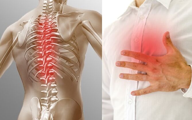 Osteochondrosis toraks menampakkan dirinya sebagai sakit dan rasa sesak di dada